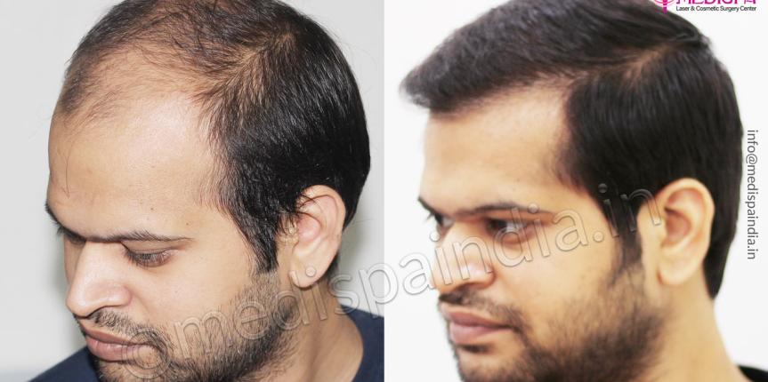 hair transplant cost in bikaner