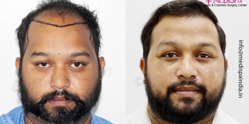 hair restoration results india