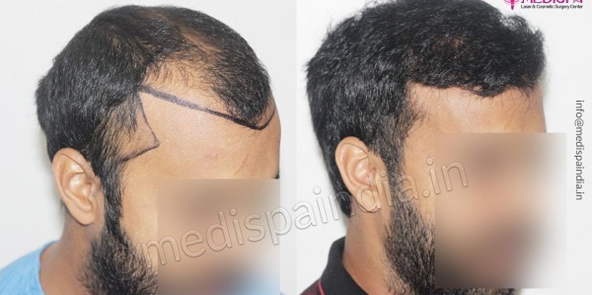 How To Know Which Hair Transplant Method Will Suit Me?