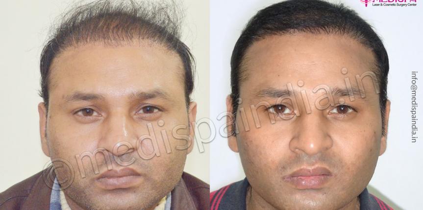 wrong hair transplant correction bangalore