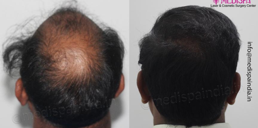 hair transplant results chennai