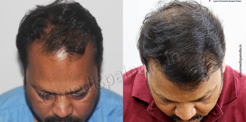 hair transplant price in delhi