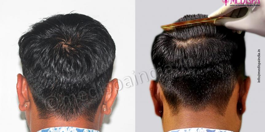 Back Head – After & Before