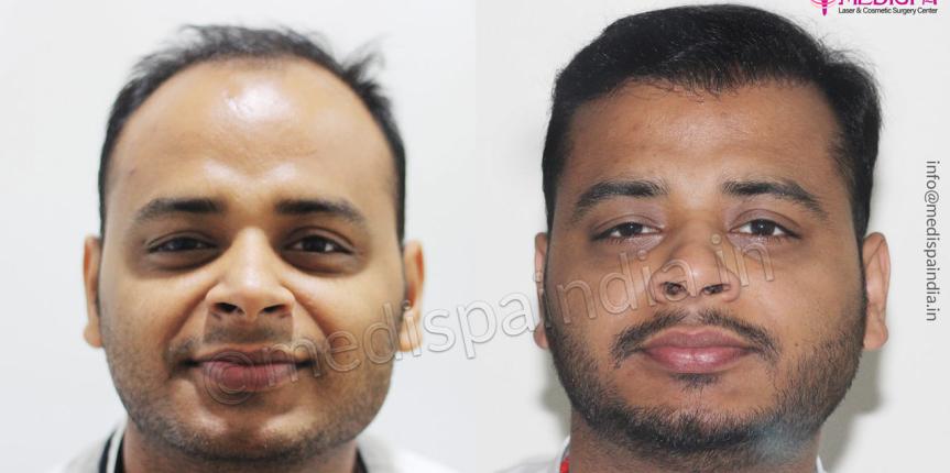 hair transplant cost in delhi