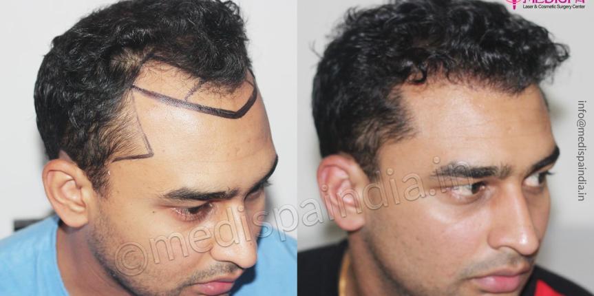 after before hair transplant results