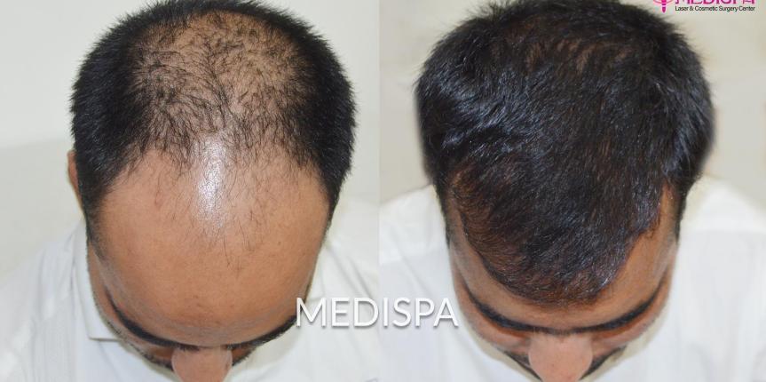 hair transplant cost in sydney australia