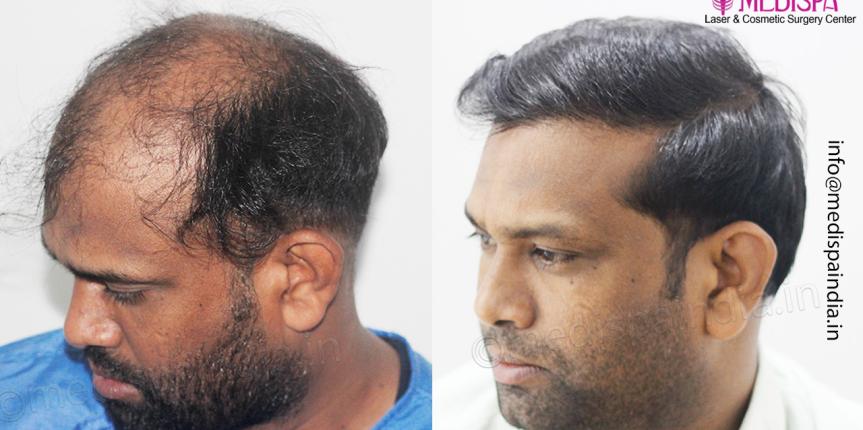 hair transplant results jaipur