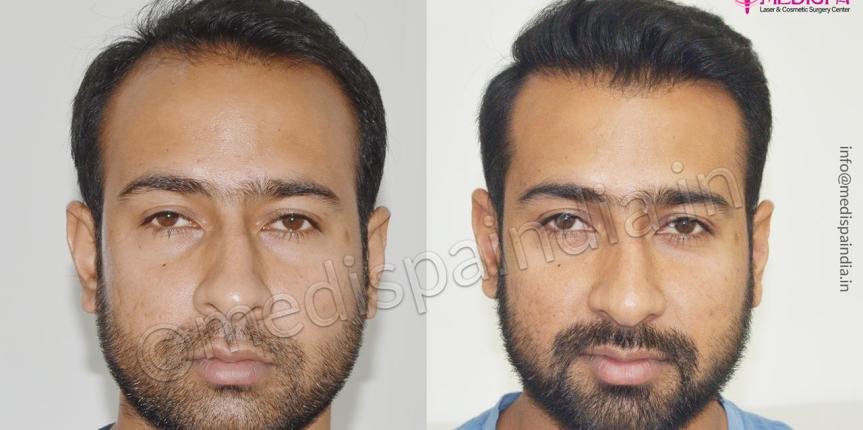 hair transplant hyderabad