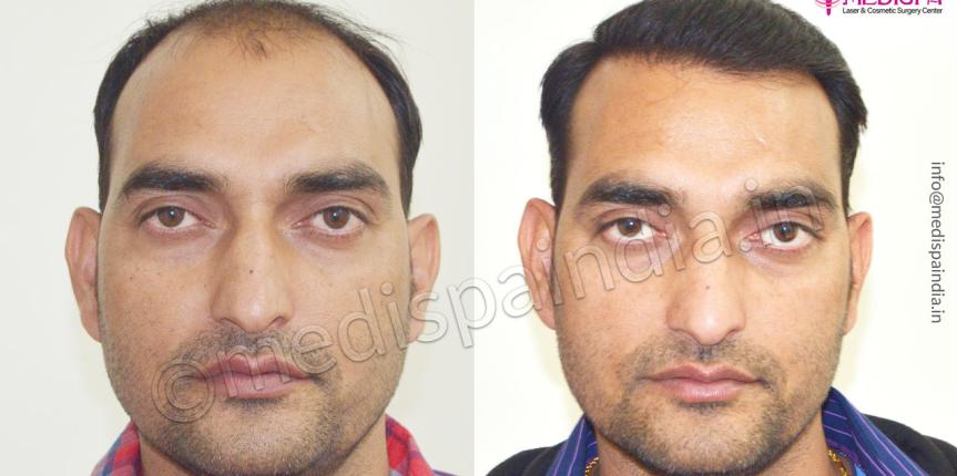 hair transplant in jodhpur