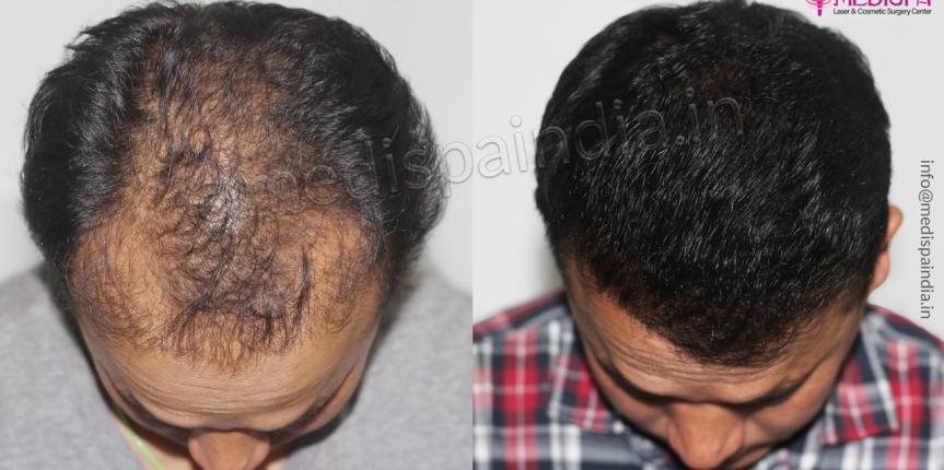 hair transplant results udaipur