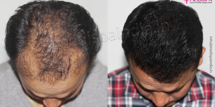 hair transplant results udaipur