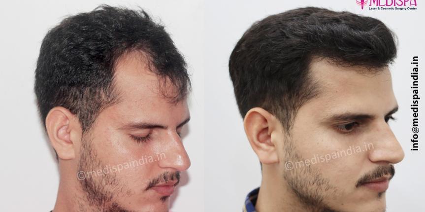 fue hair transplant price