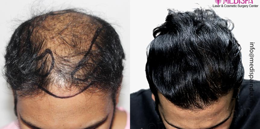 hair transplant results after 10 months