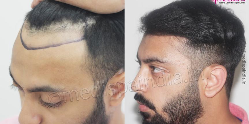 cost of hair transplant jaipur