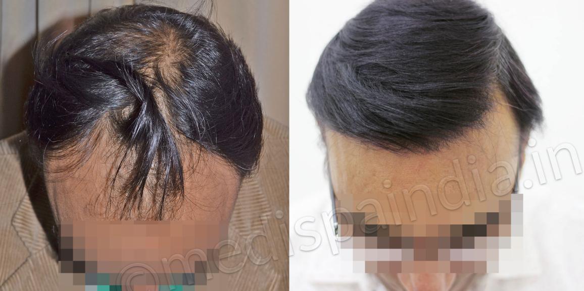 What is the Significance of Primary Consultation in Hair Transplants