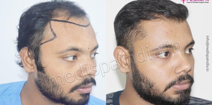 fue hair transplant