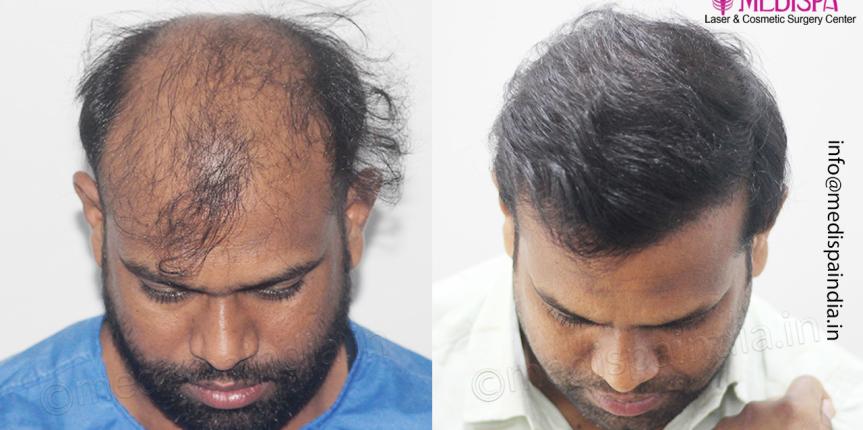 hair transplant results delhi