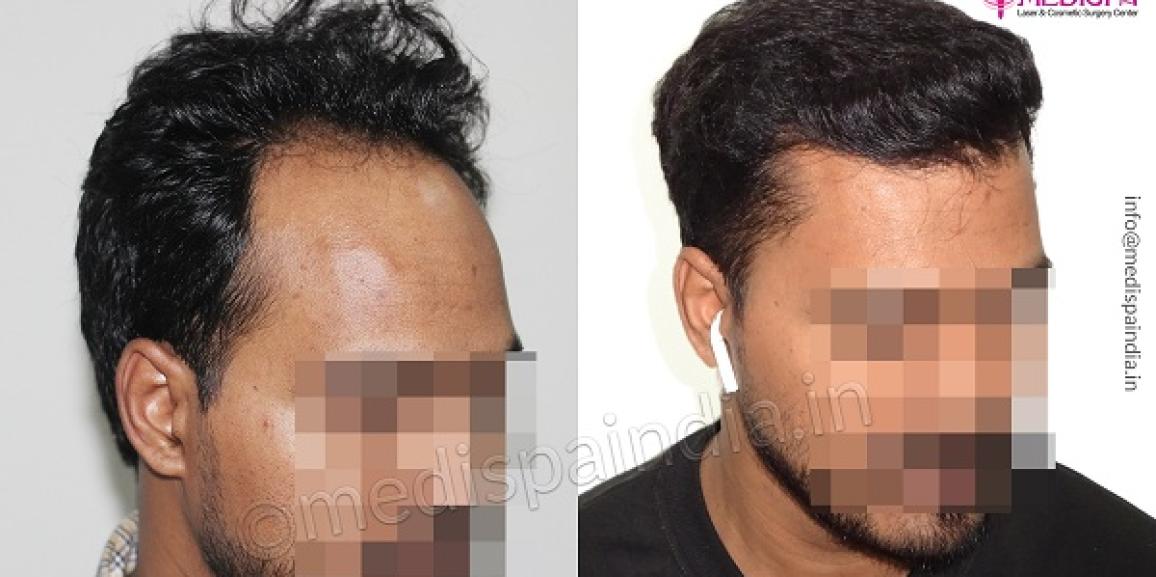 Why Scalp Assessment is Mandatory Before Hair Transplant?