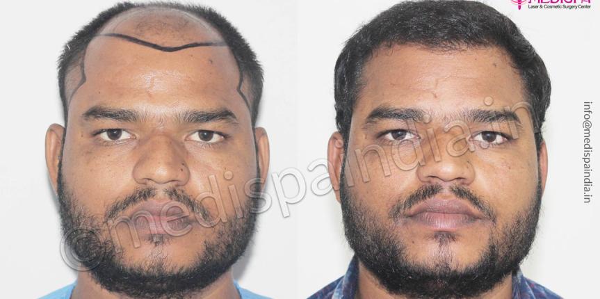 hair transplant in nigeria