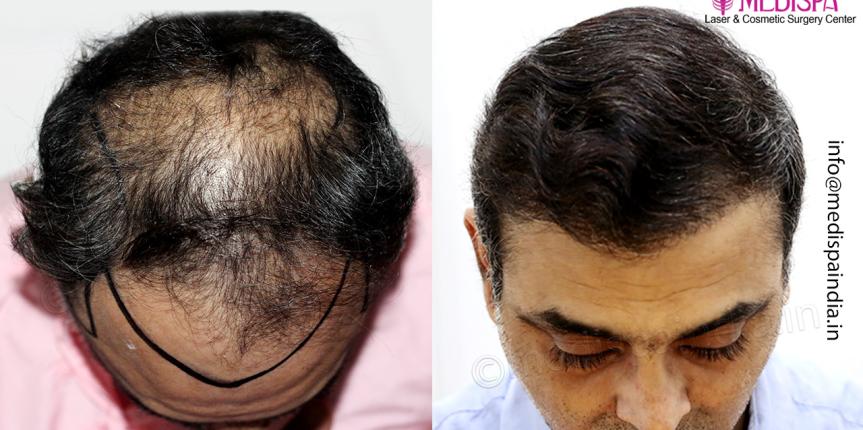 best hair transplant result india delhi