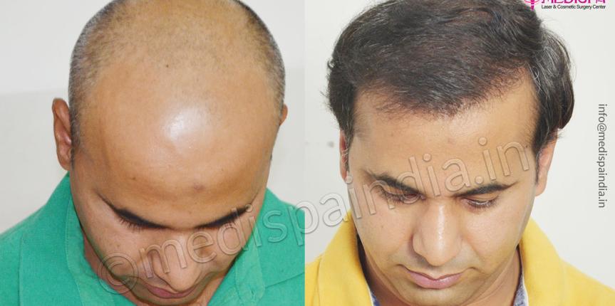 hair transplant cost in usa