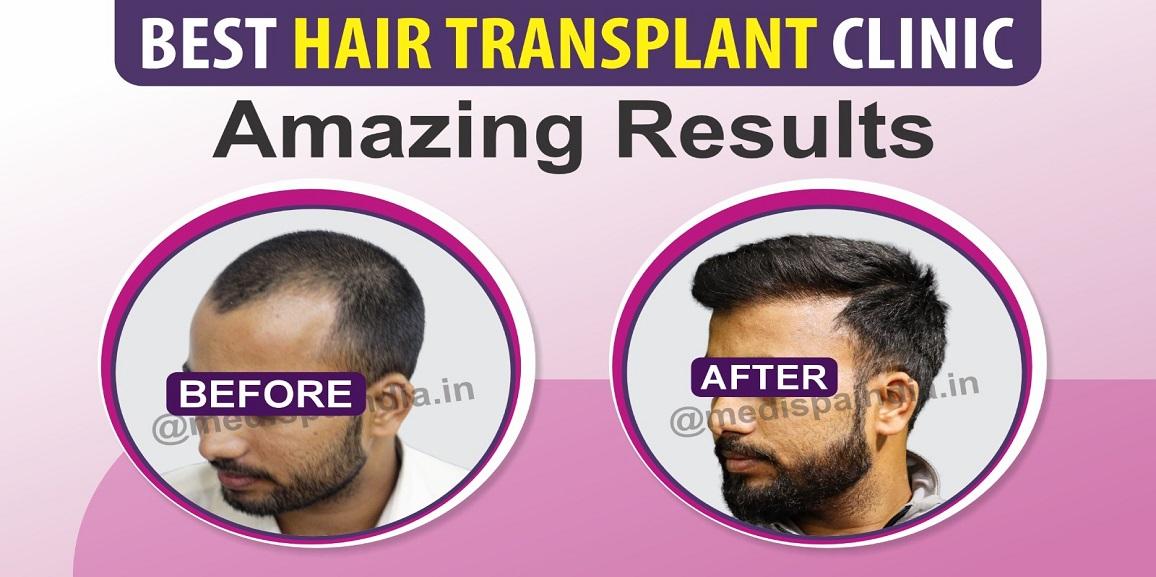 Get Over Your Baldness Issue With Hair Transplant Surgery