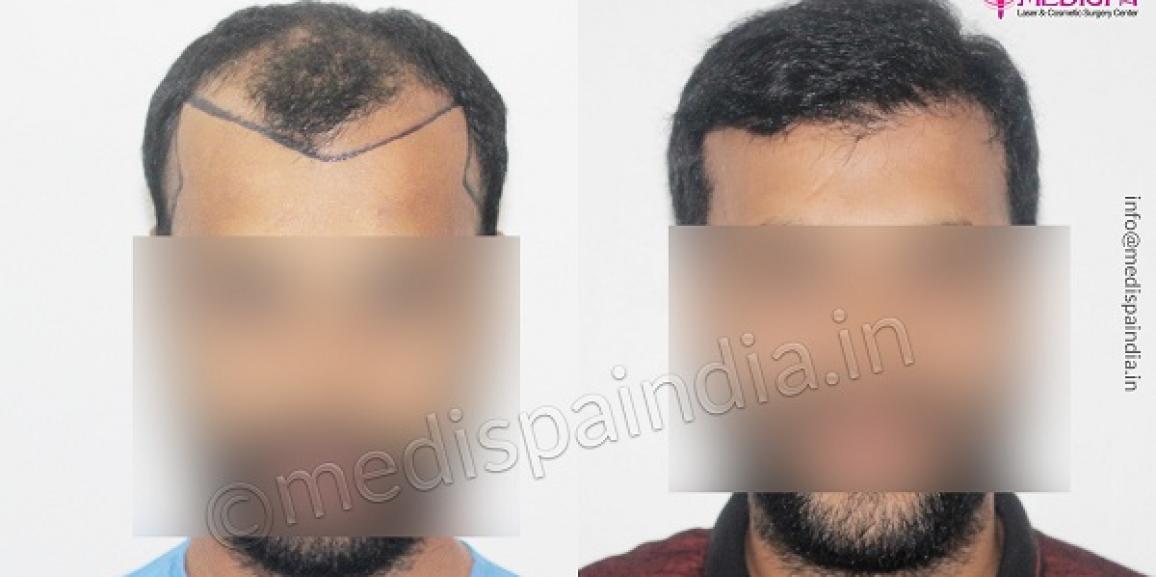 What Are The Precautionary Measures Should Be Followed After Hair Transplant?