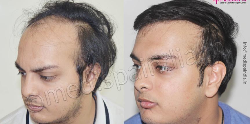 hair transplant cost in jodhpur