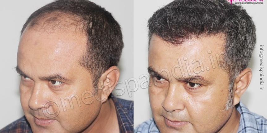 hair transplant dubai after before