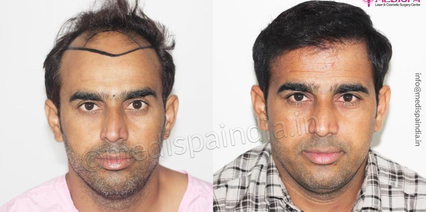 best hair transplant in jaipur india