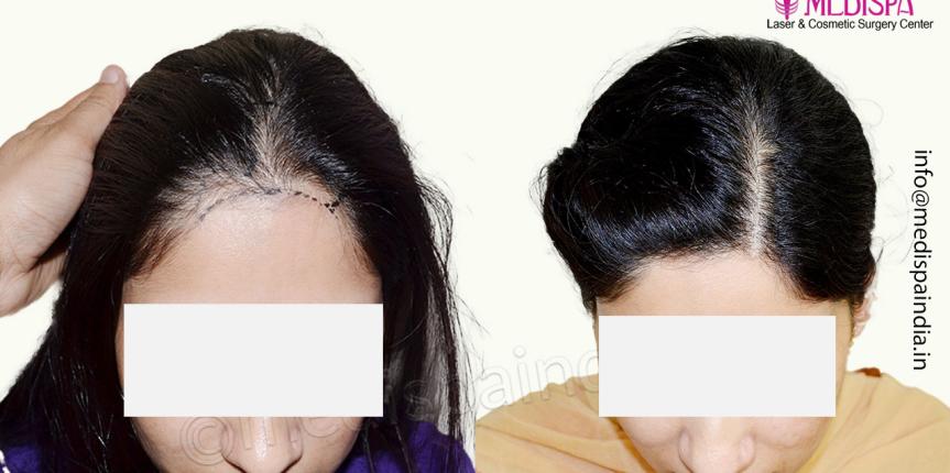 female hair transplant jaipur