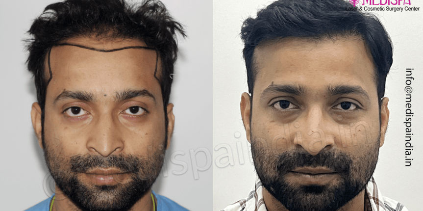 hyderabad hair transplant