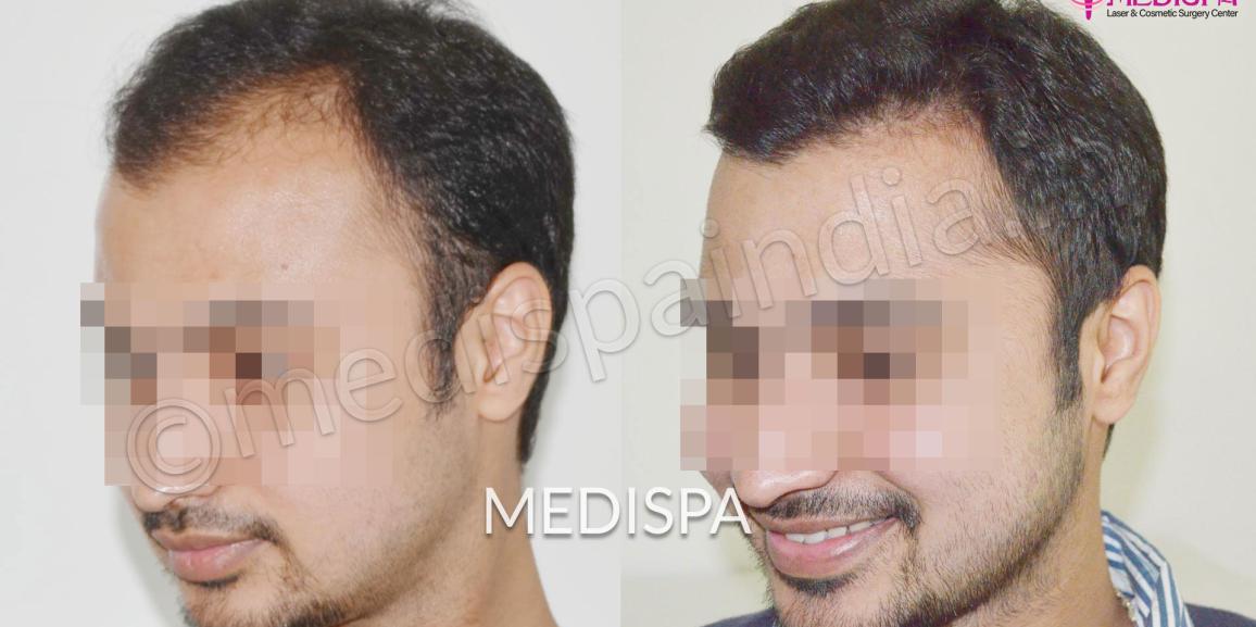 Which Technique is Better FUT or FUE Hair Transplant