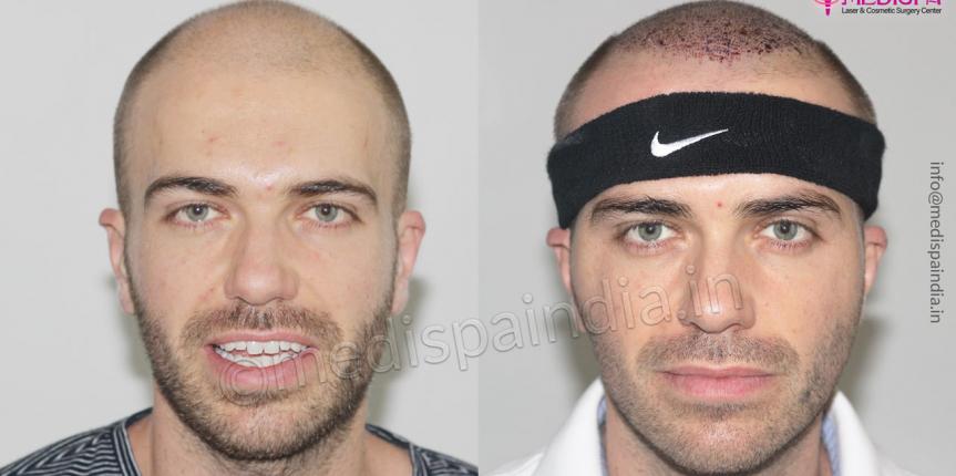 australian hair transplant results