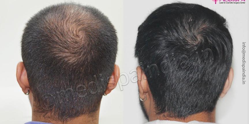 hair restoration canada