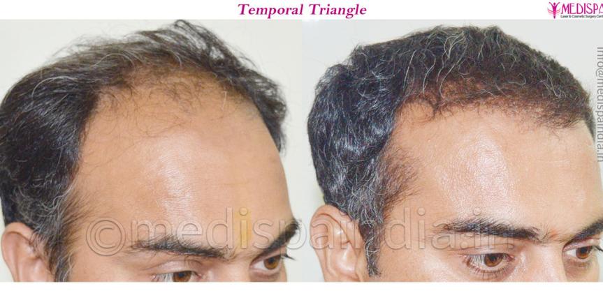 hair restoration in surat