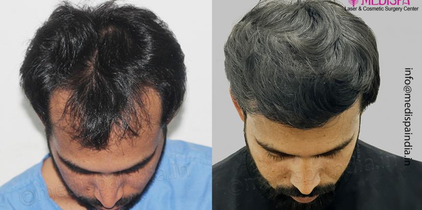 Fue hair transplant results