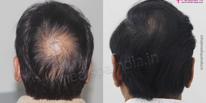 Hair Transplant India after before