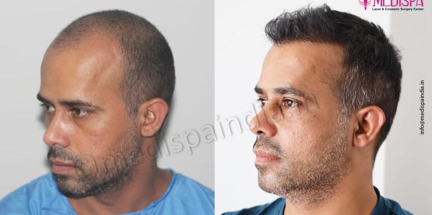 best hair restoration results india