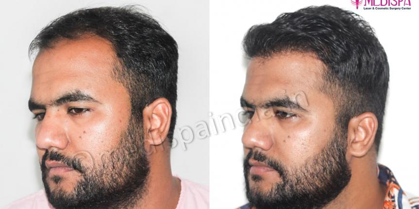best hair restoration results in rajasthan