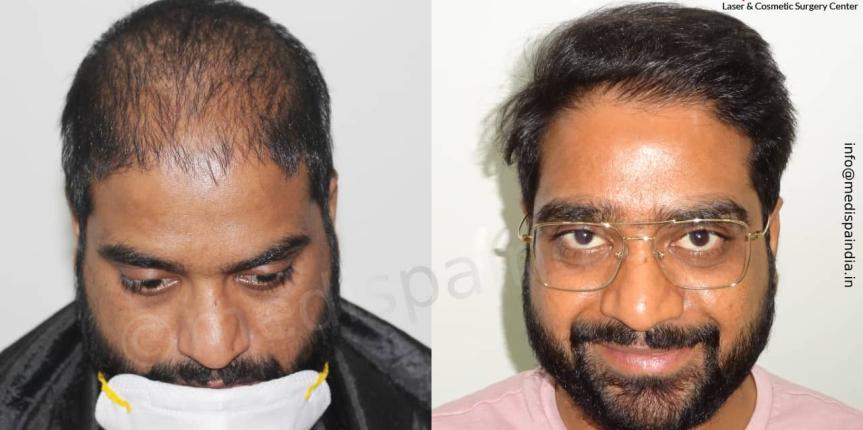 hair transplant cost in delhi