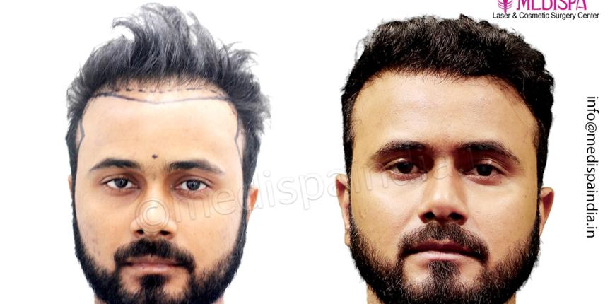 hair transplant india results