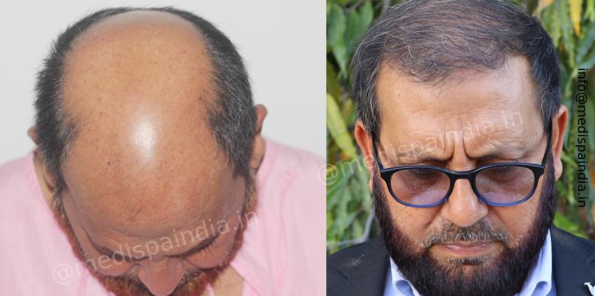 hair transplant hyderabad