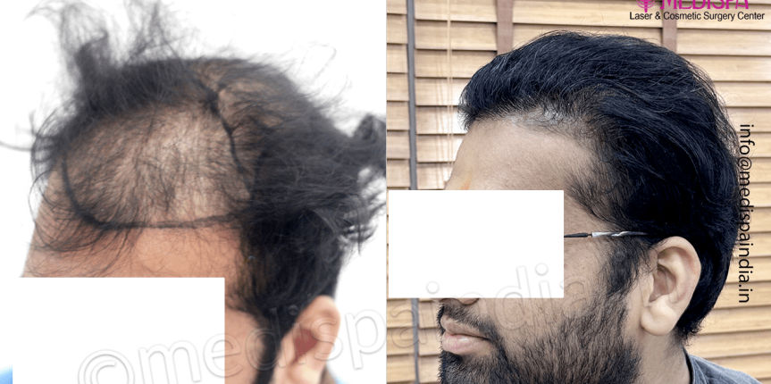 delhi-hair-transplant