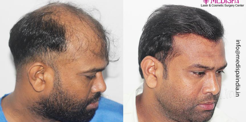 hair transplant results bangalore