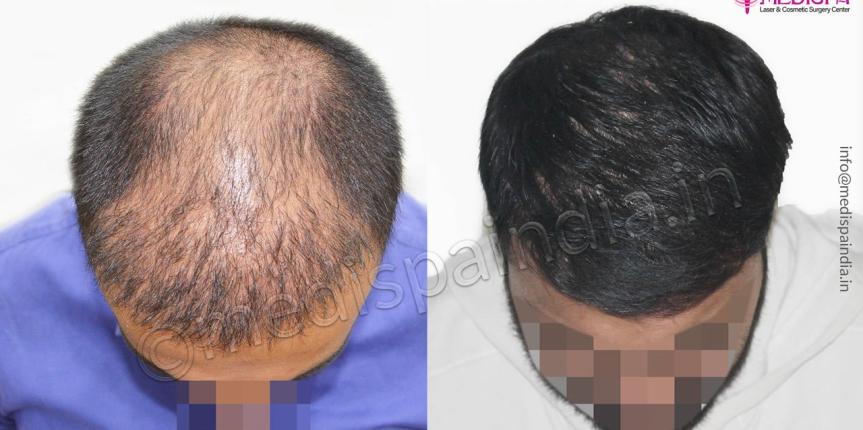 hair transplant in jammu and kashmir