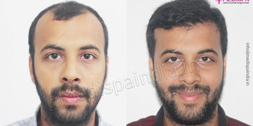 best hair transplant results Hyderabad