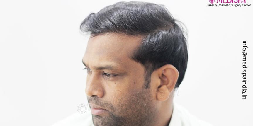 hair transplant results hyderabad