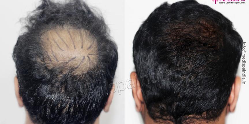 Hair Transplant Delhi results