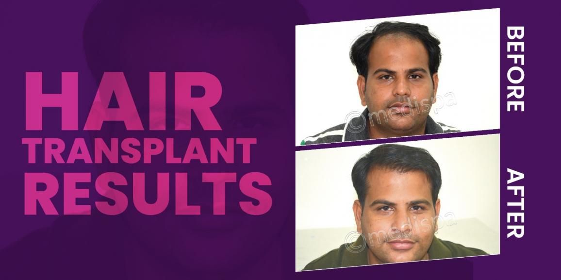 Unlock Your Hair’s Potential: Get Expert Hair Transplant Treatment